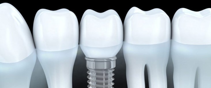Are Dental Implants Right for You? Exploring Candidacy and Eligibility