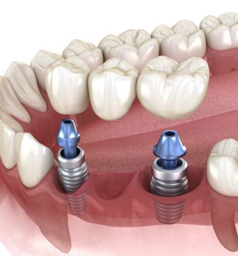 Are Dental Implants Right For You Exploring Candidacy And Eligibility, Dental Implants Suitability Assessment, Evaluating Dental Implants Candidature, Eligibility for Dental Implants, Dental Implants Viability, Dental Implants Feasibility, Dental Implants Applicability, Dental Implants Suitability Exploration, Dental Implants Eligibility Investigation, Dental Implants Candidacy Probe, Dental Implants Rightness Examination, Dental Implants Eligibility Analysis, Dental Implants Suitability Scrutiny, Dental Implants Adequacy Review, Dental Implants Applicability Appraisal, Dental Implants Suitability Inquiry, Dental Implants Eligibility Check, Dental Implants Candidacy Assessment, Dental Implants Rightness Survey, Dental Implants Eligibility Appraisal, Dental Implants Suitability Examination, Dental Implants Candidature Analysis, Dental Implants Viability Scrutiny, Dental Implants Feasibility Review